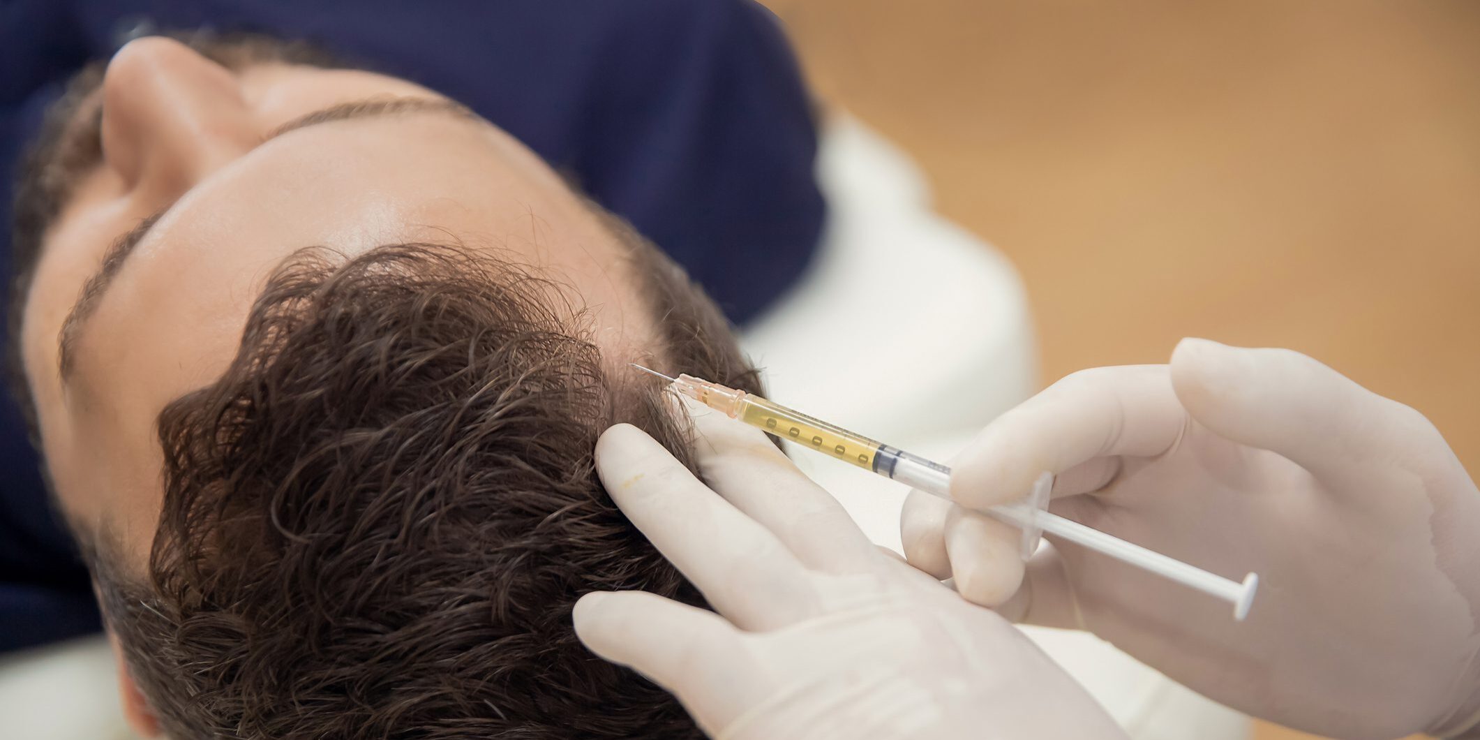 Hair mesotherapy or scalp prp: Platelet-rich plasma procedure. Beautician doctor makes injections in the man head for hair growth against hair loss and baldness